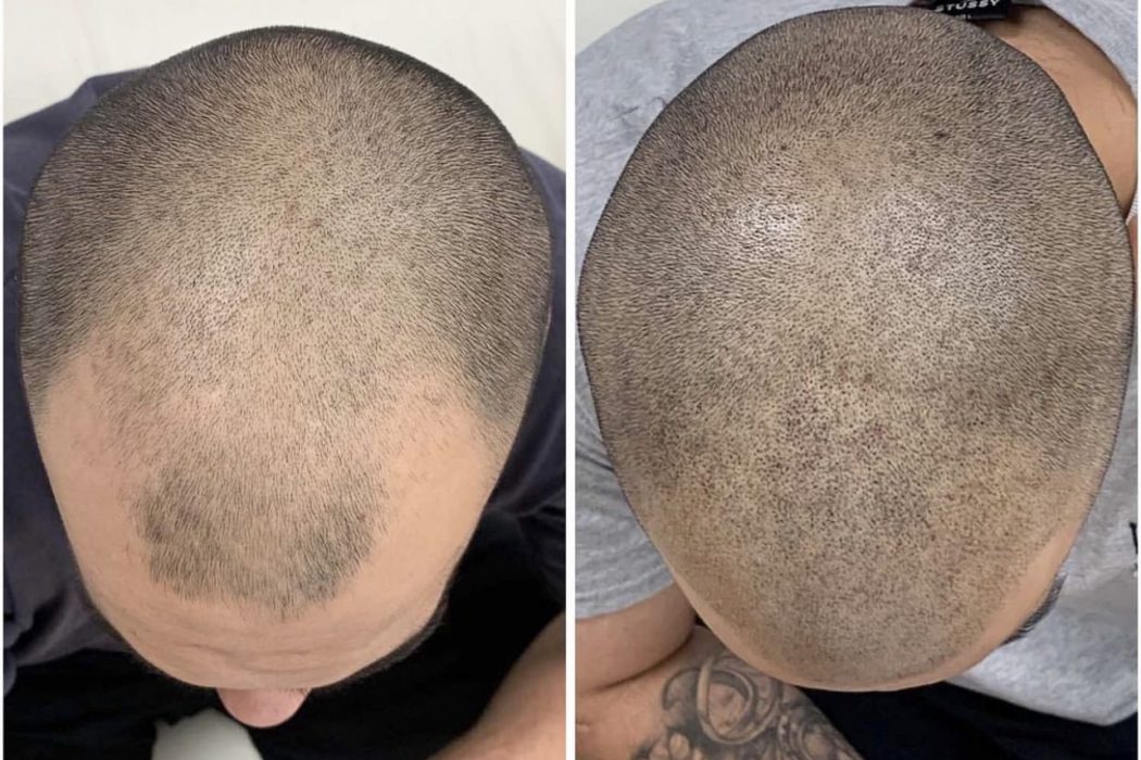 Scalp Micropigmentation