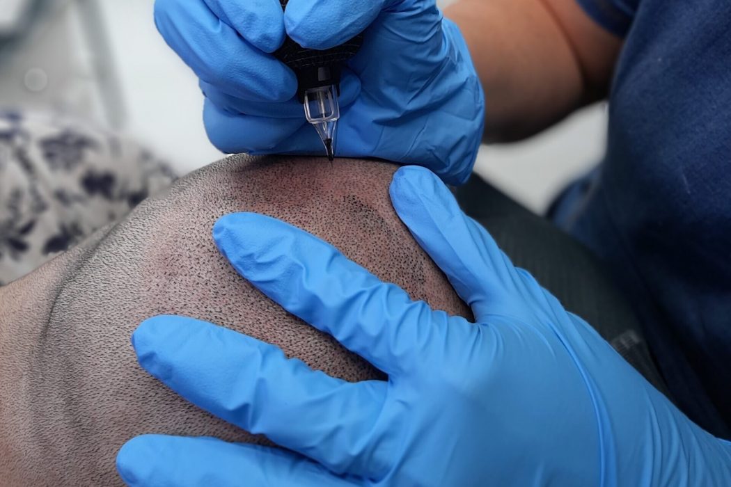 Scalp Micro-pigmentation Bangalore