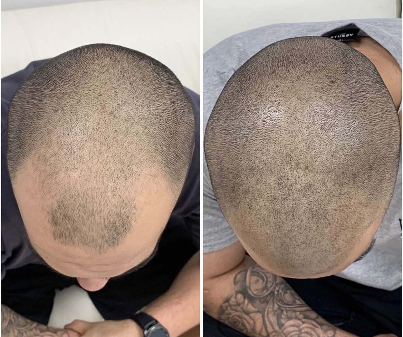 Is Scalp Micro-Pigmentation Painful? ⋆ Tampa Scalp Ink