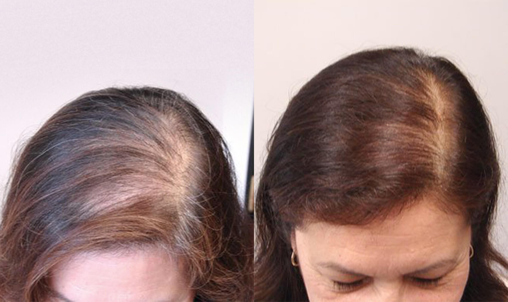 RF treatment for Hair(radio frequency)