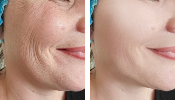 hydra facial before after