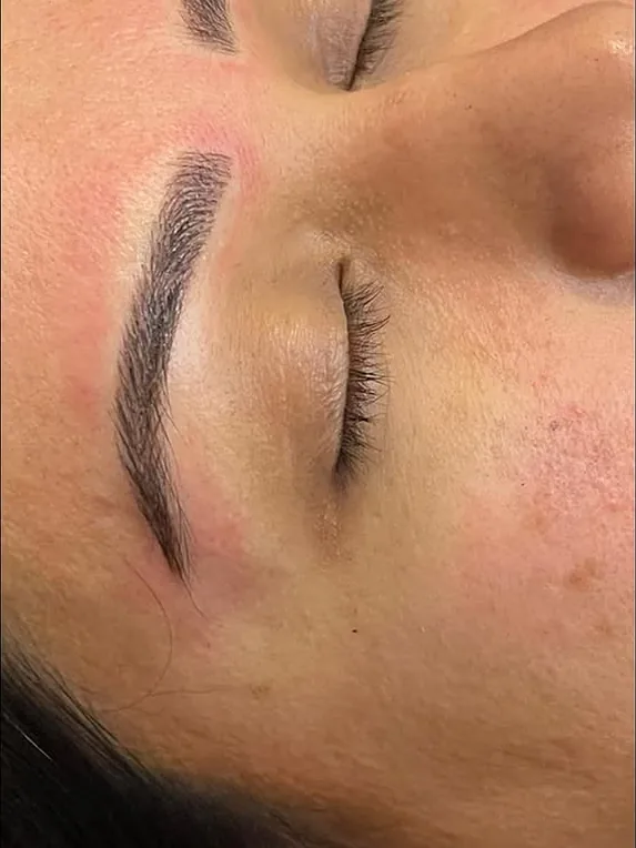Healed brow result, eyes closed