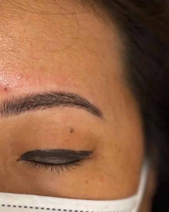 Nanoblading result, healed
