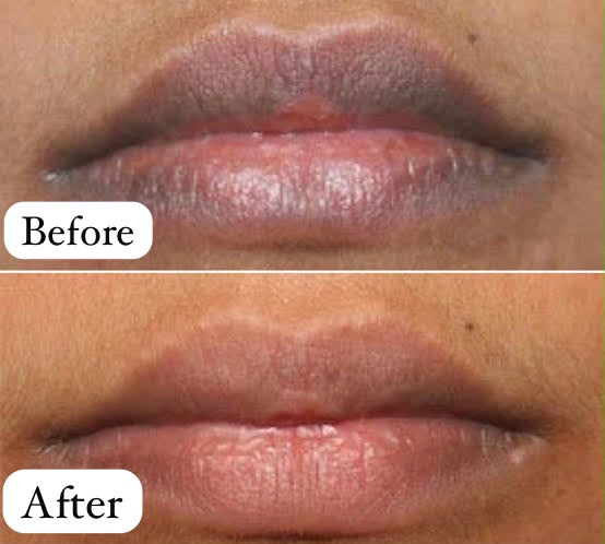 Dark, pigmented lips before lip blush, and soft naturally pink lips after the lip tattoo treatment in Bangalore