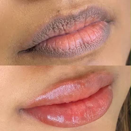 Grey, two-toned lip pigmentation before treatment, and an even, healthy lip tone after the dark lips colour correction